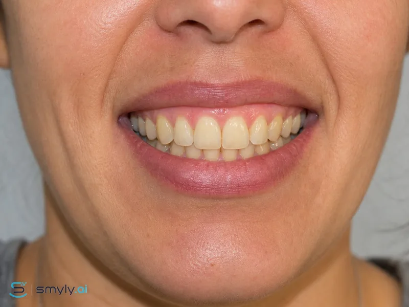Before: the same smile, untreated