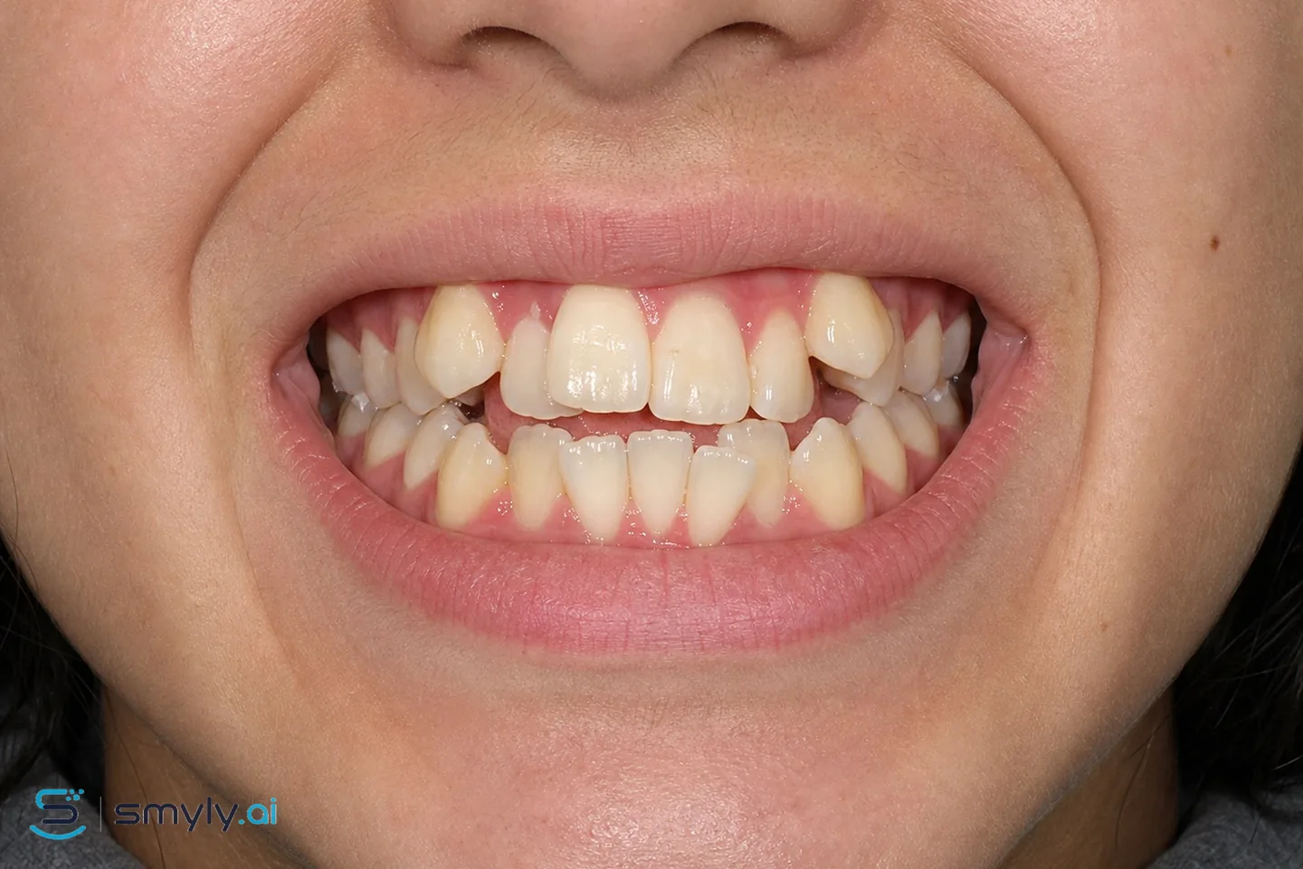 Before: sample smile before braces preview