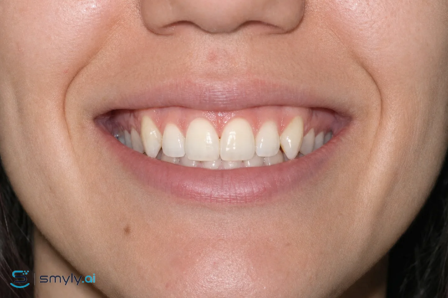 After: Smyly simulation of canine reshaping on the same smile