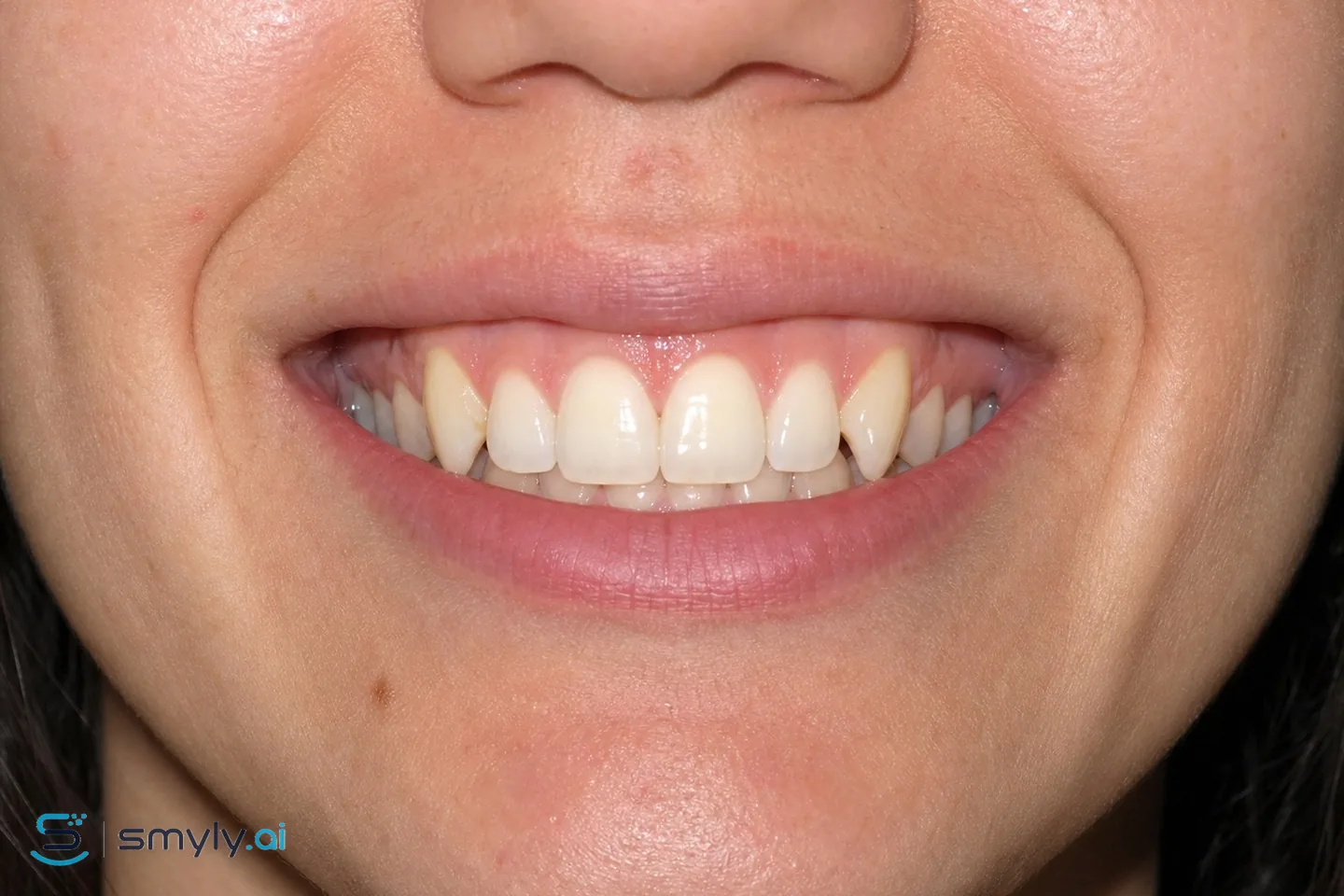 Before: sample smile before canine reshaping