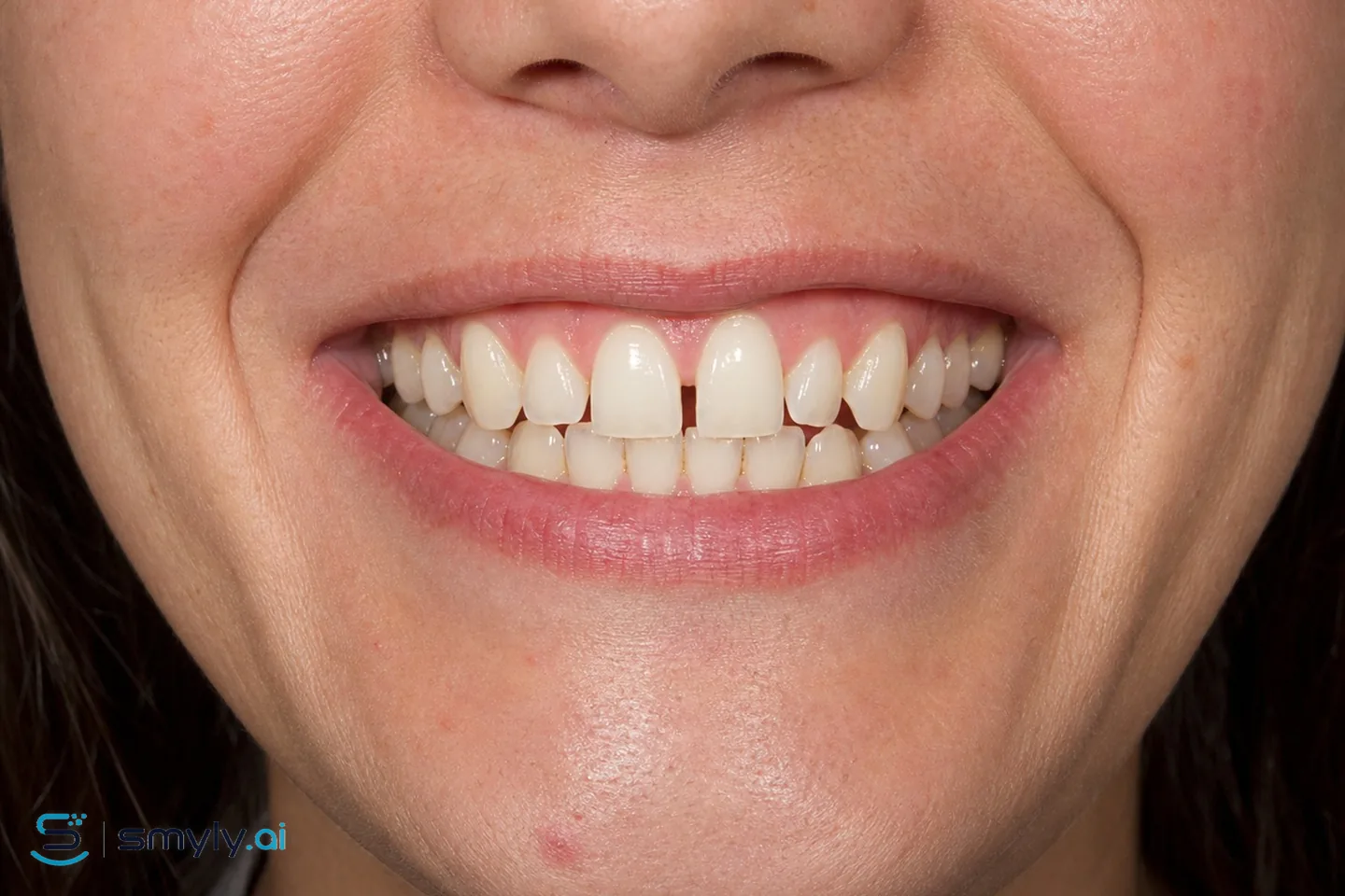 Before: sample smile before clear aligners