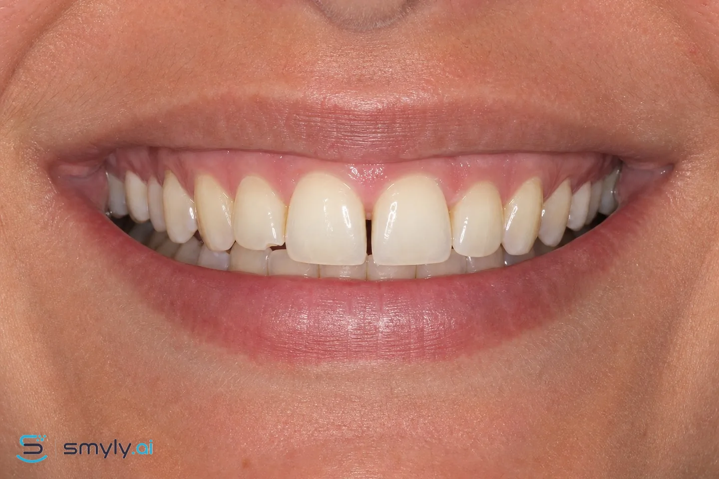 Before: sample smile before composite bonding