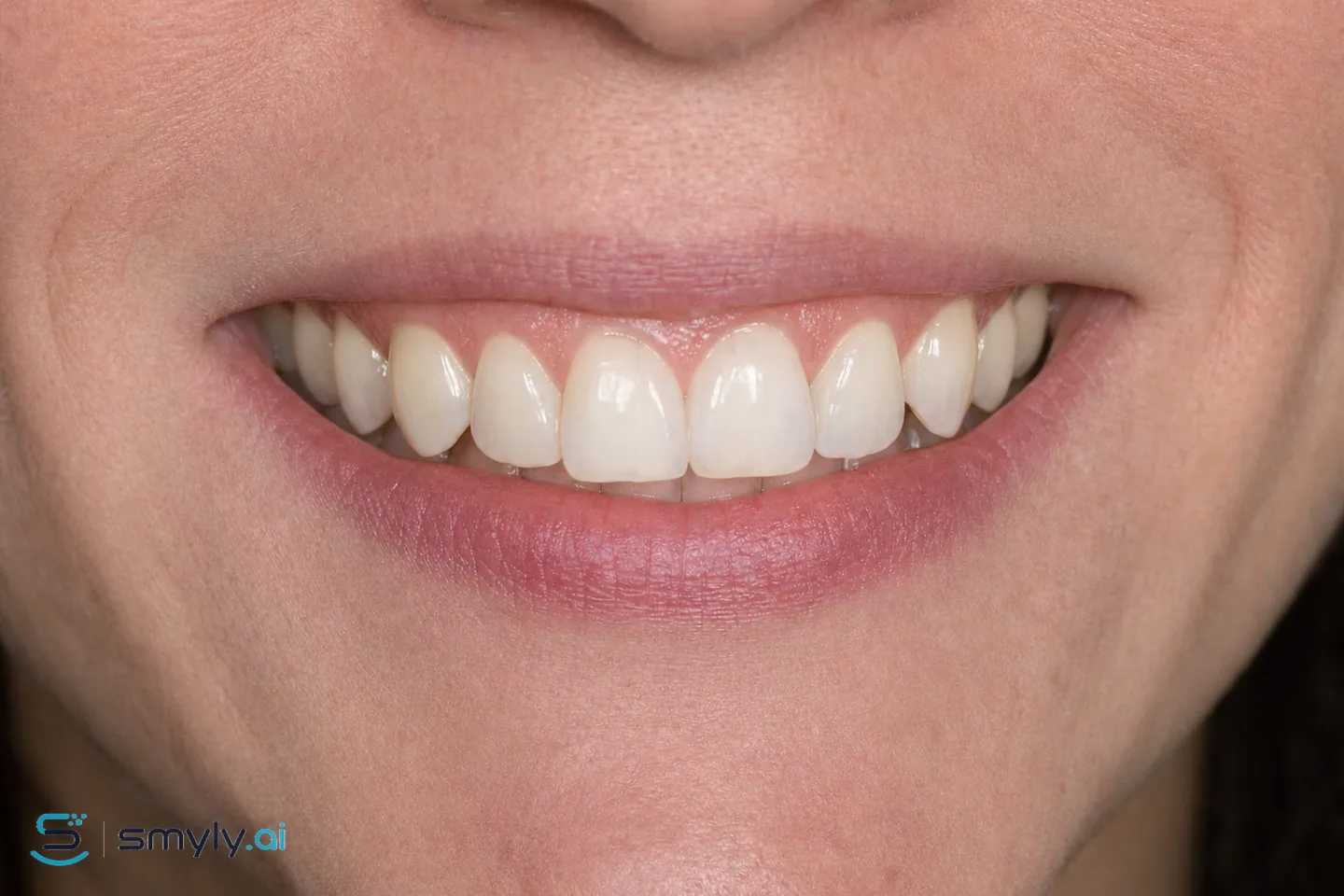 After: Smyly simulation of craze line smoothing on the same smile