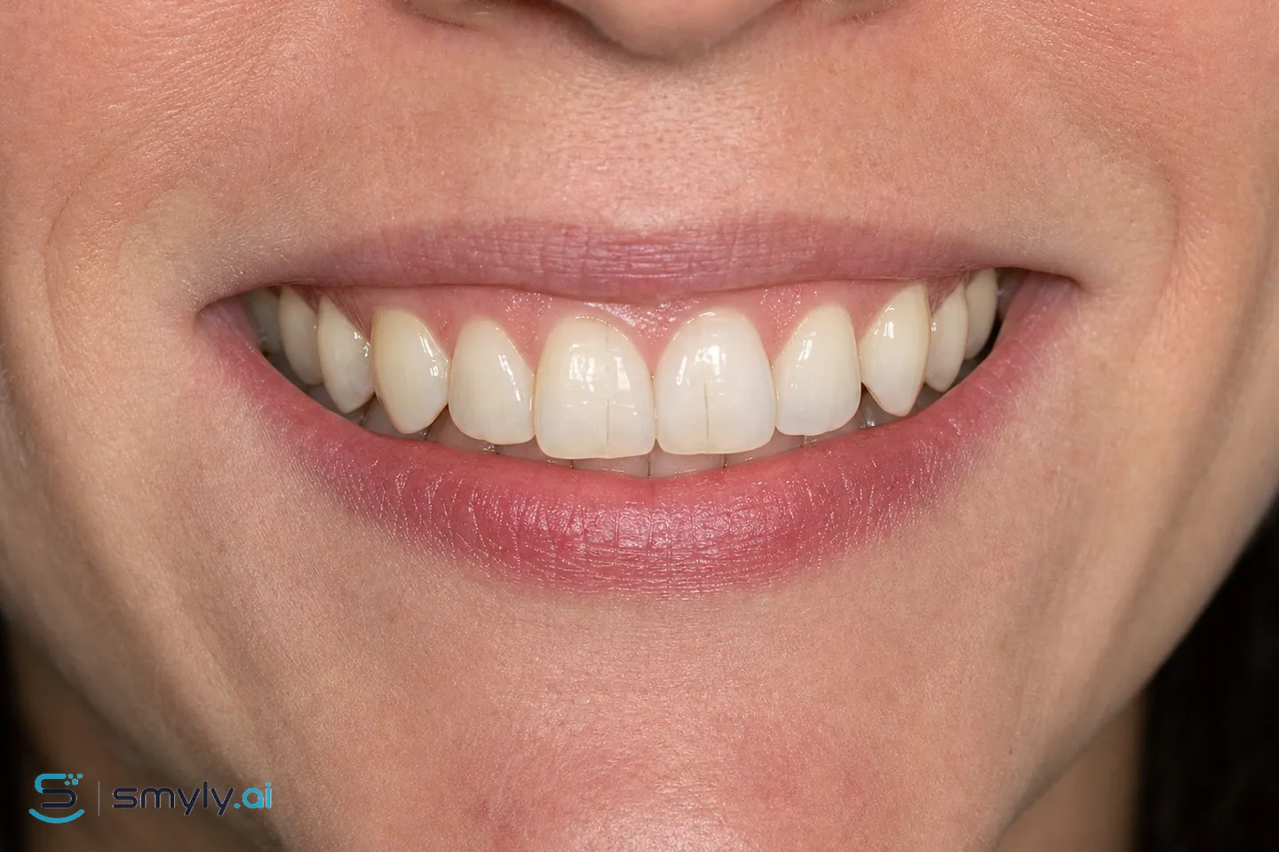 Before: sample smile before craze line smoothing