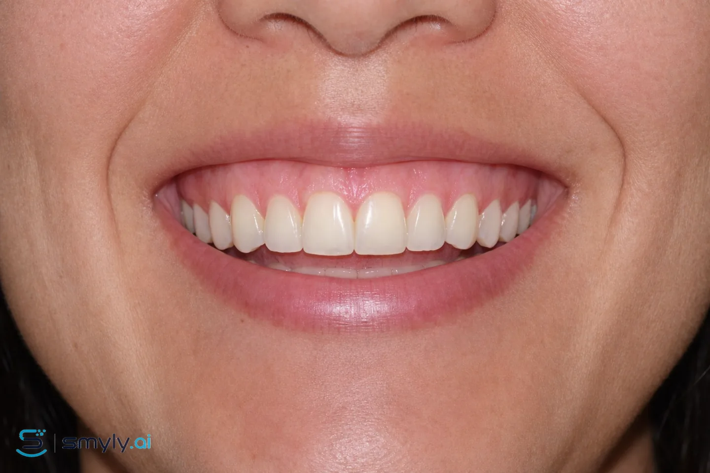 After: Smyly simulation of crown lengthening on the same smile
