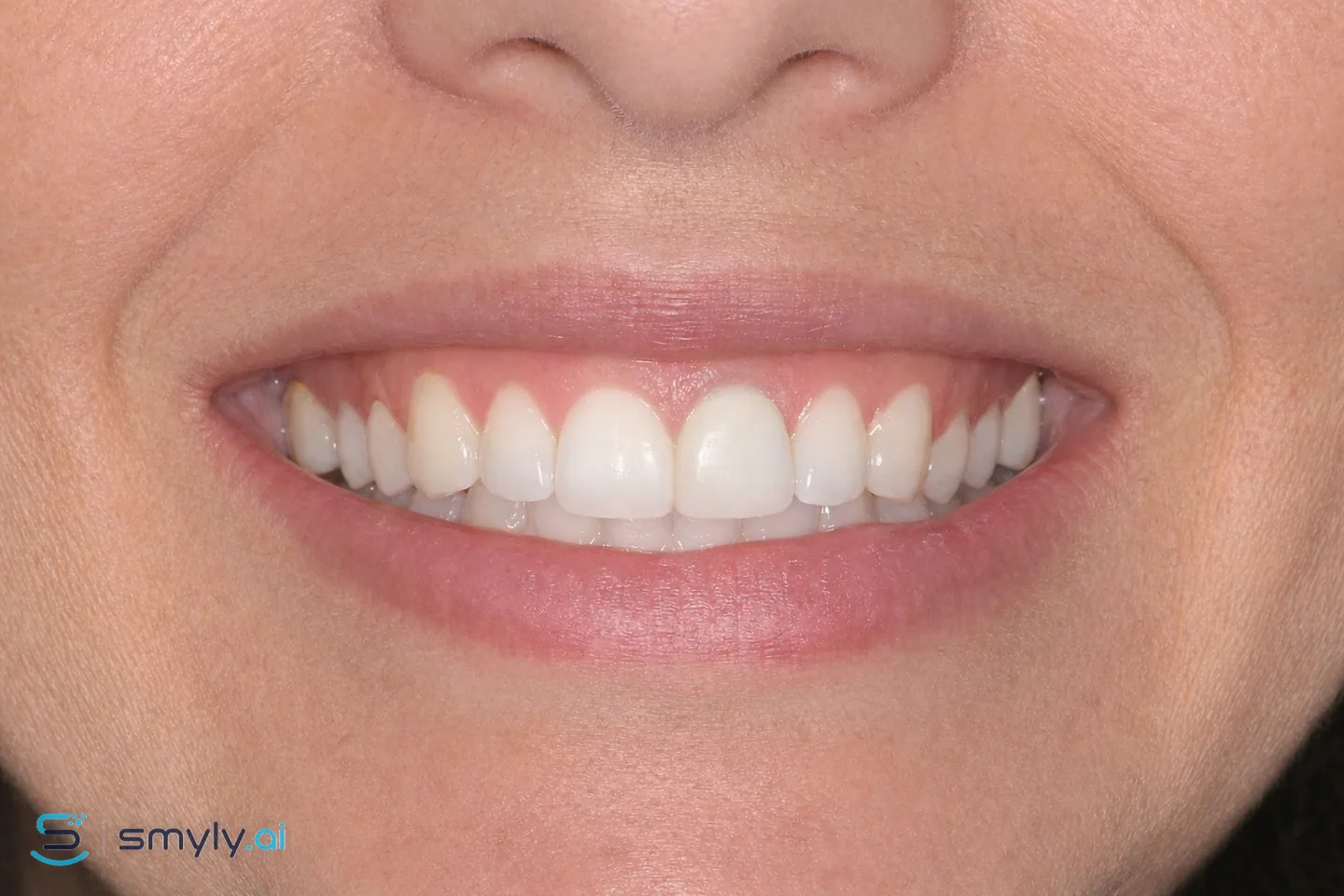 After: Smyly simulation of dark crown line fix on the same smile