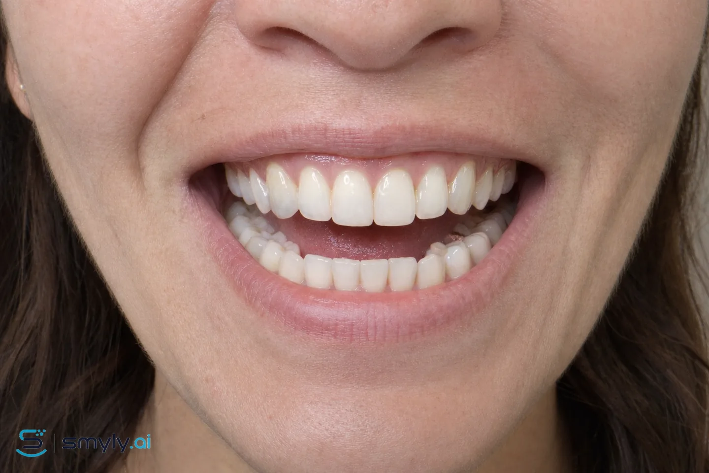 After: Smyly simulation of replace metal fillings on the same smile
