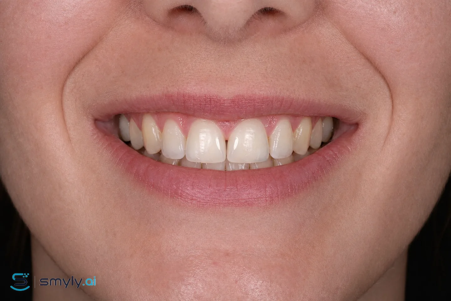 After: Smyly simulation of gap closure on the same smile