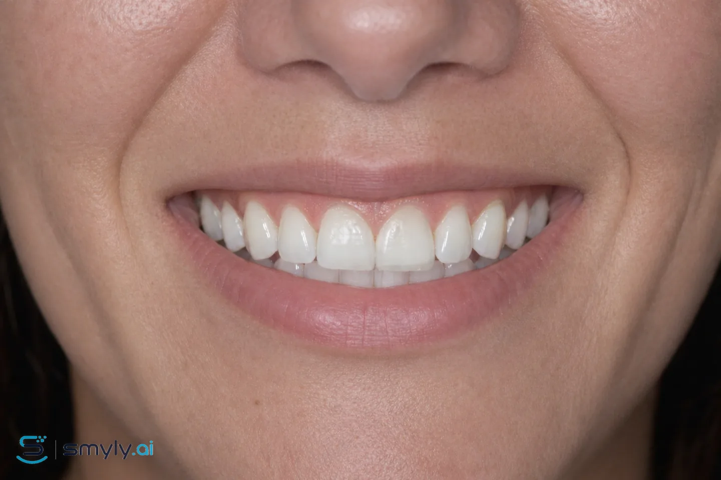 After: Smyly simulation of refresh old bonding on the same smile