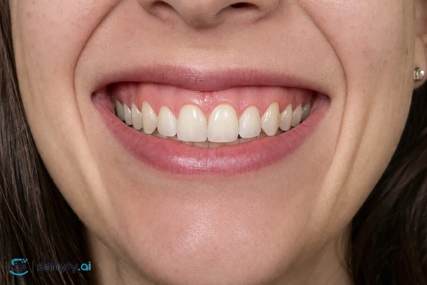 After: Smyly simulation of gum contouring on the same smile