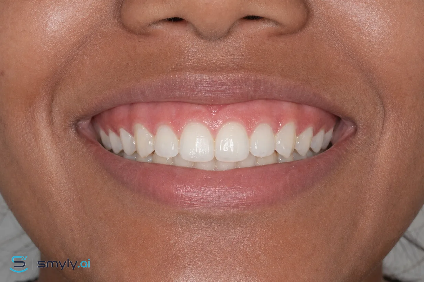 After: Smyly simulation of gum depigmentation on the same smile