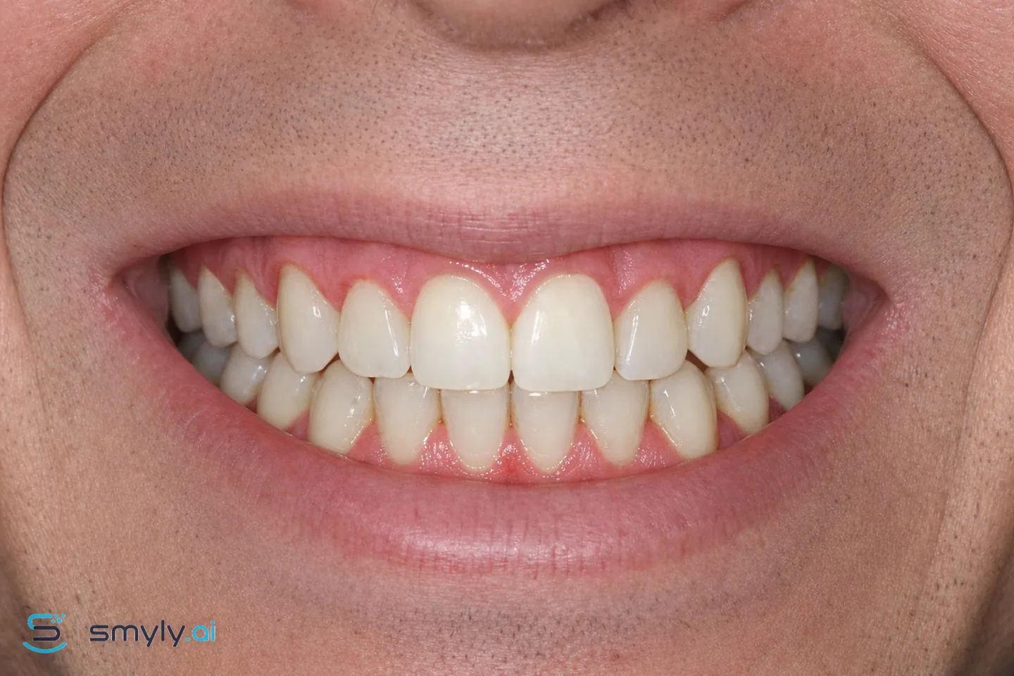 After: Smyly simulation of healthy gums on the same smile