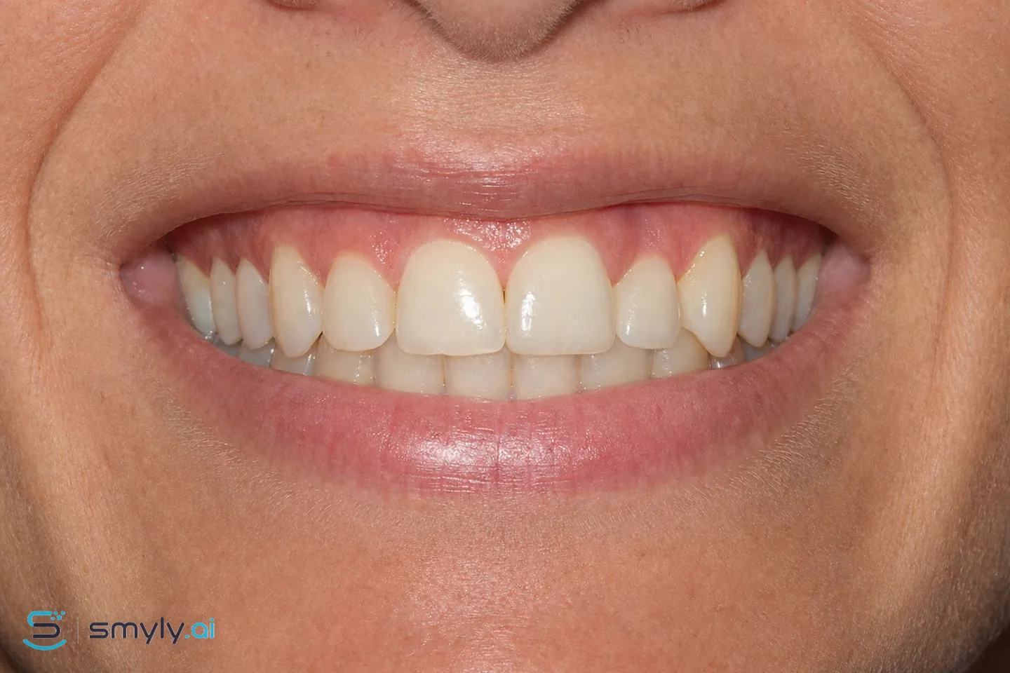 After: Smyly simulation of single implant on the same smile