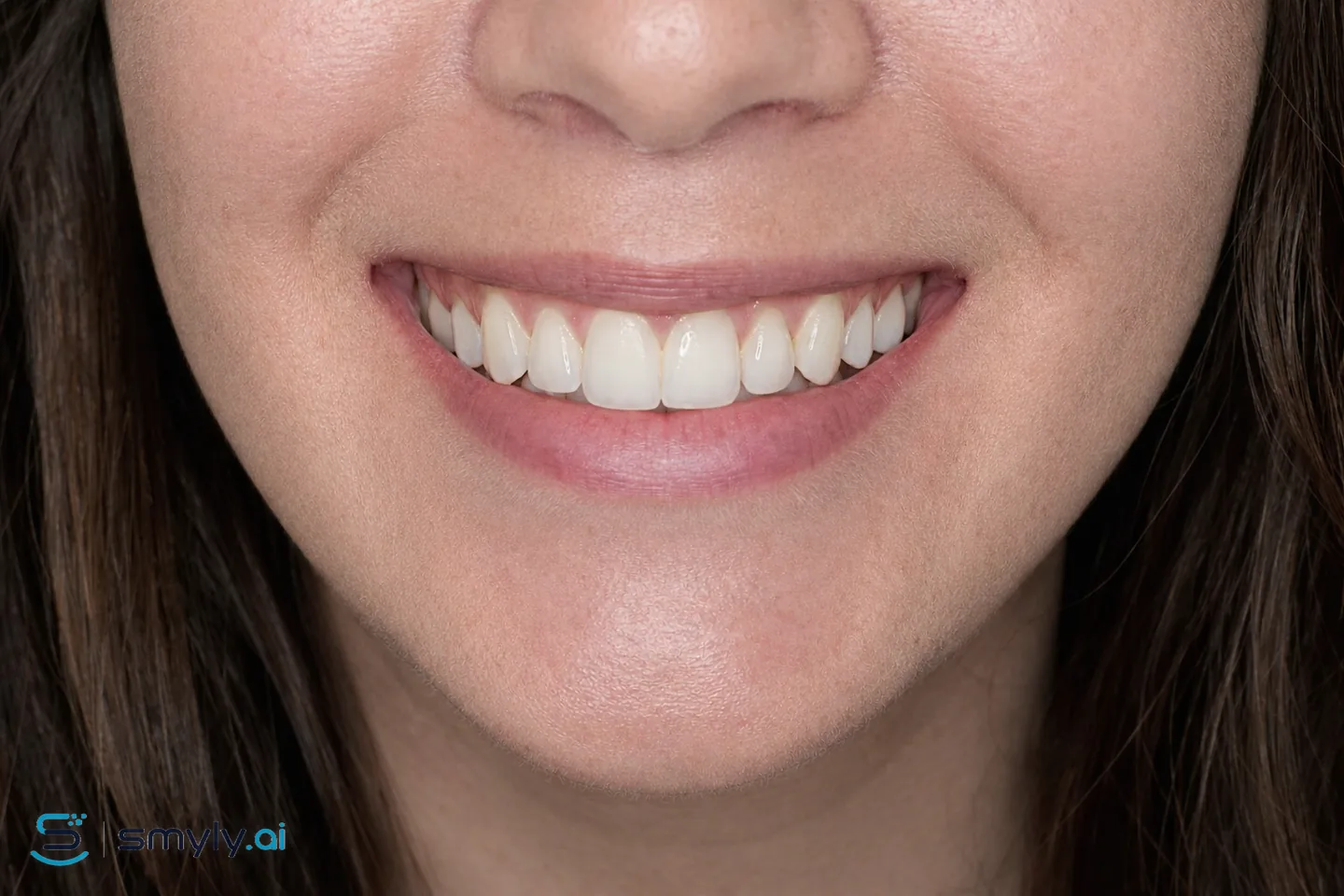After: Smyly simulation of small tooth buildup on the same smile