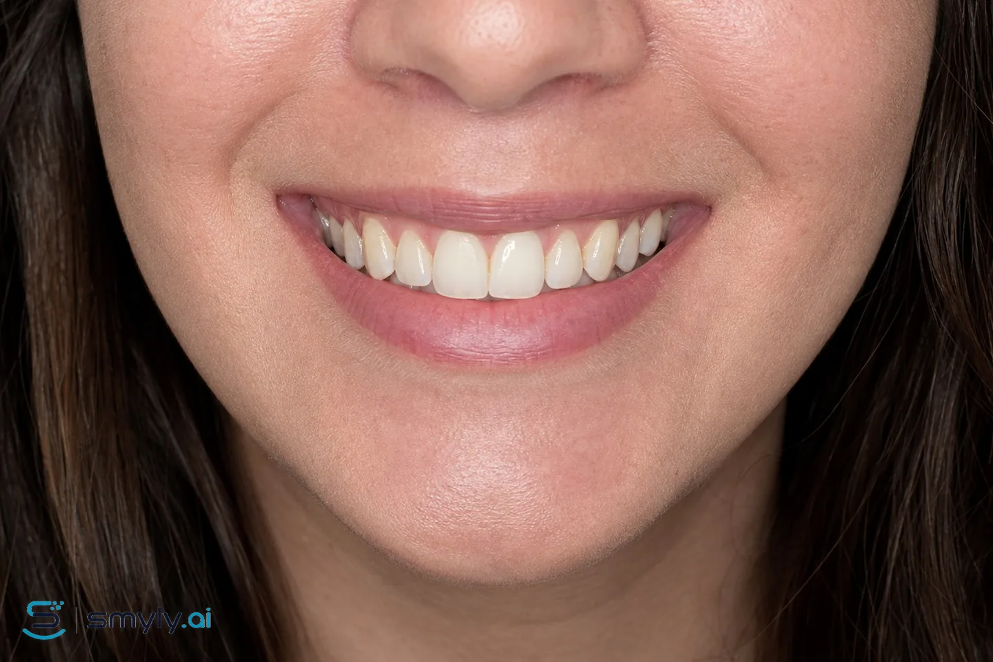 Before: sample smile before small tooth buildup