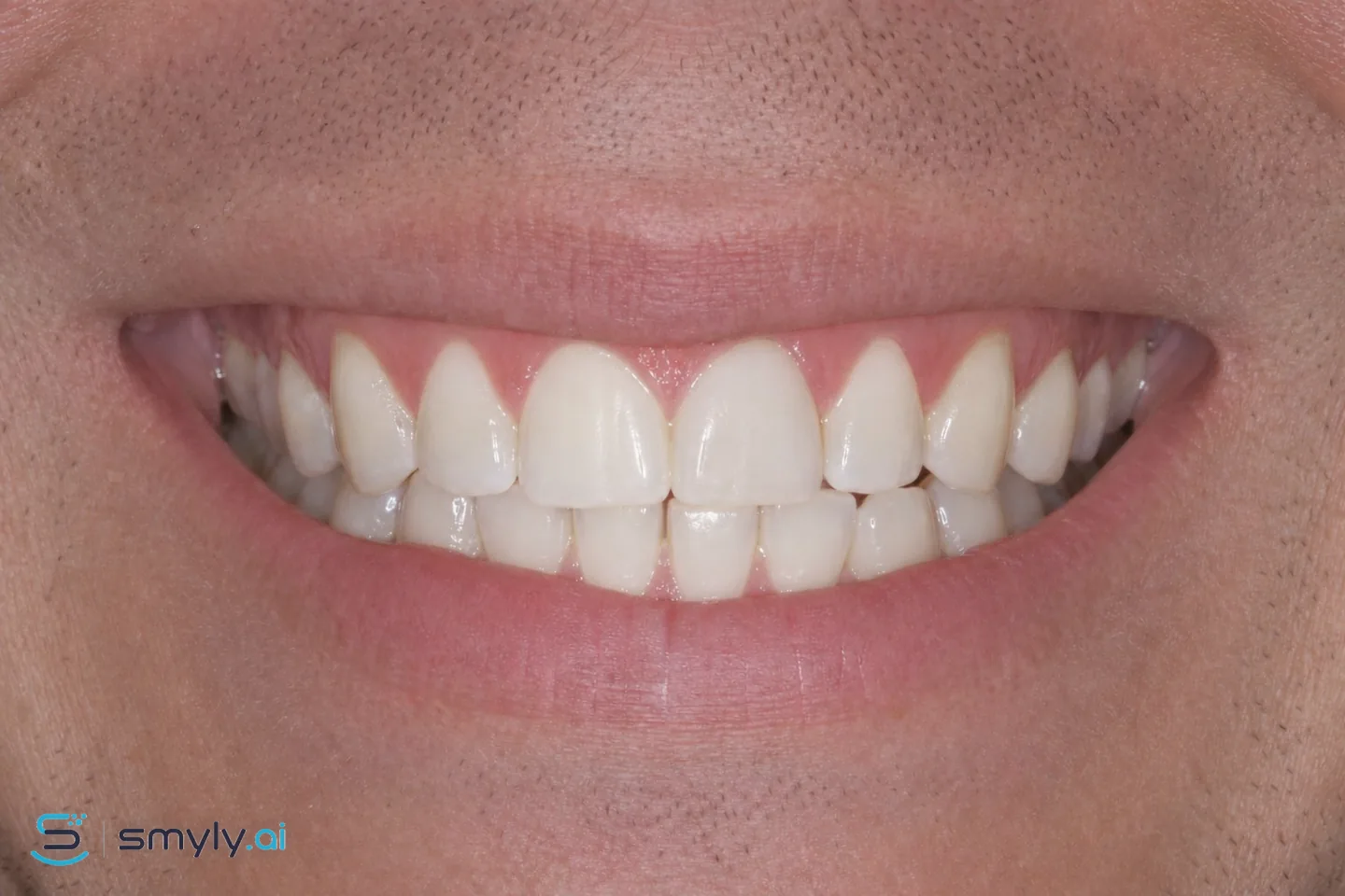 After: Smyly simulation of single dark tooth on the same smile