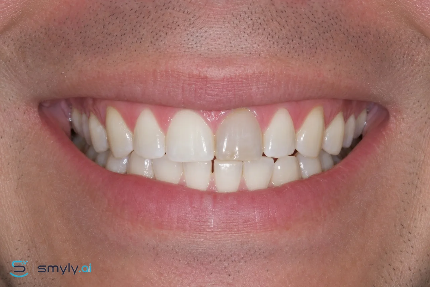 Before: sample smile before single dark tooth