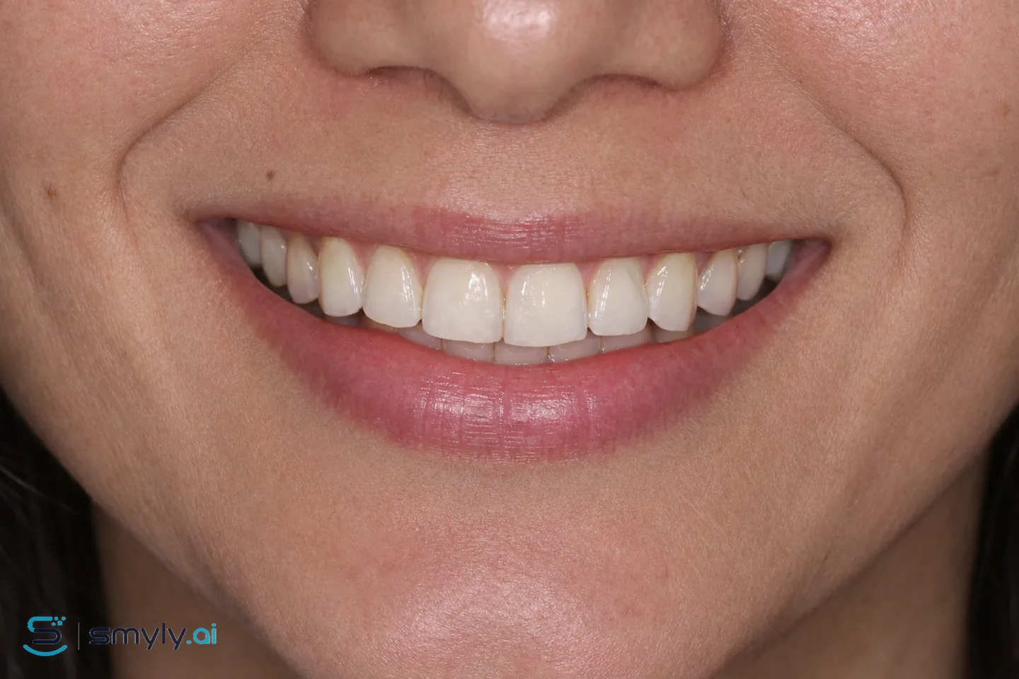 After: Smyly simulation of smile design on the same smile
