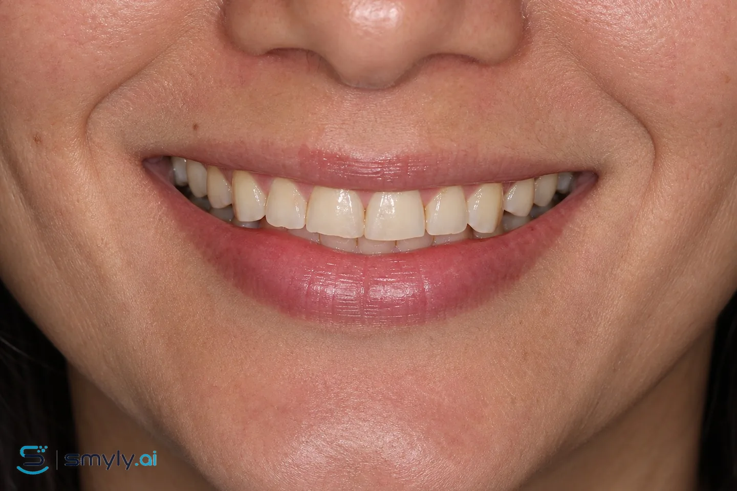 Before: sample smile before smile design