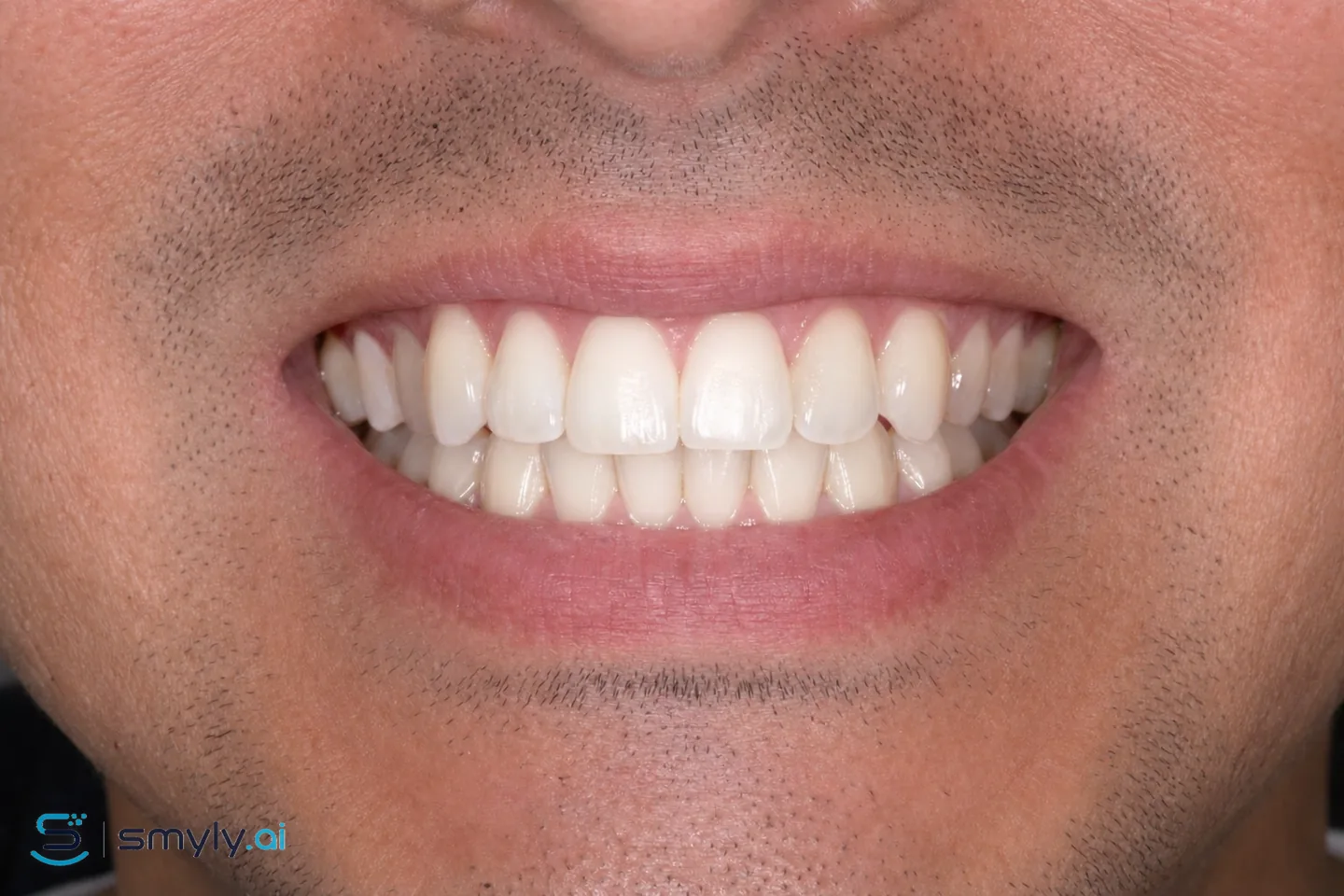After: Smyly simulation of front tooth cavity repair on the same smile