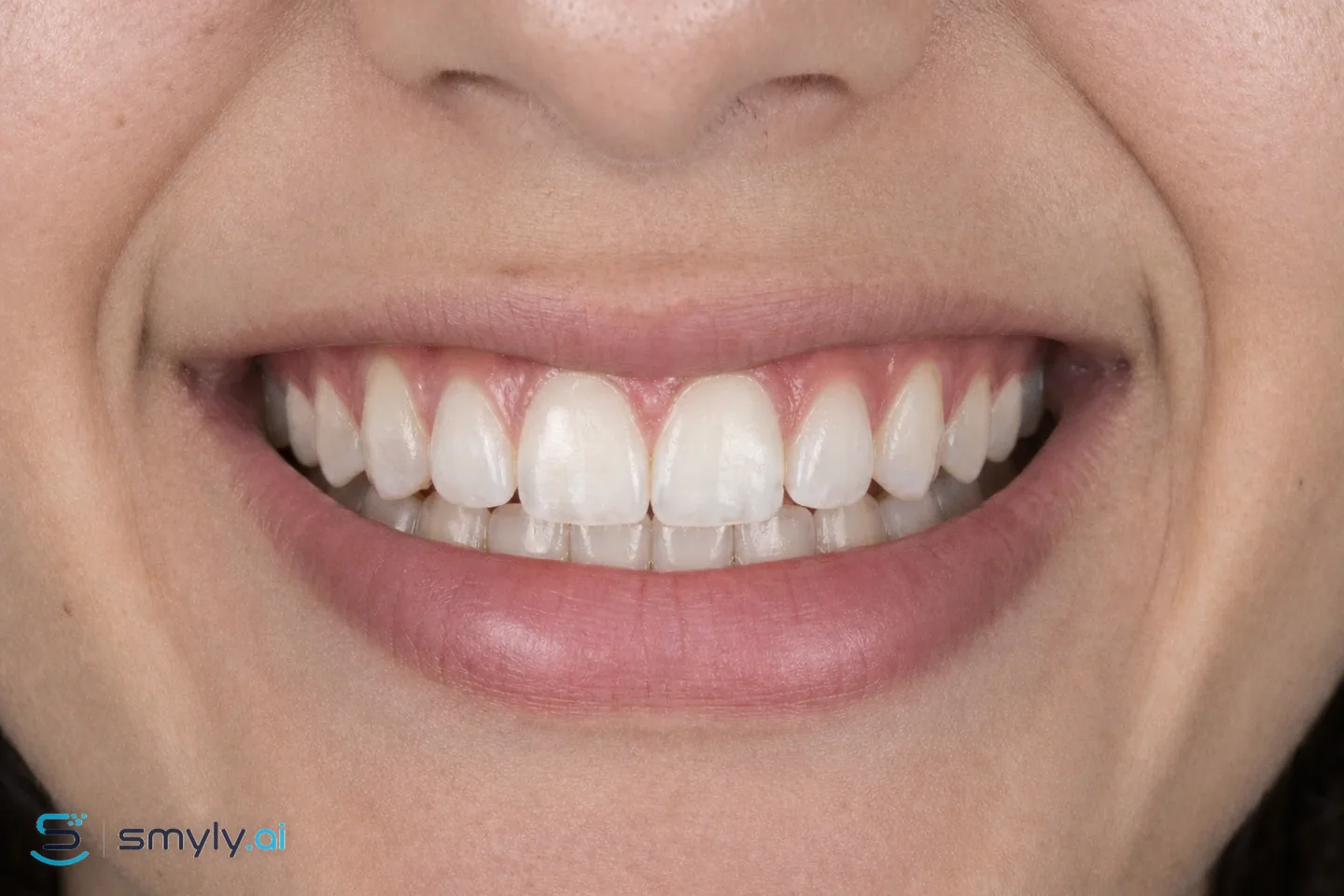 After: Smyly simulation of white spot treatment on the same smile