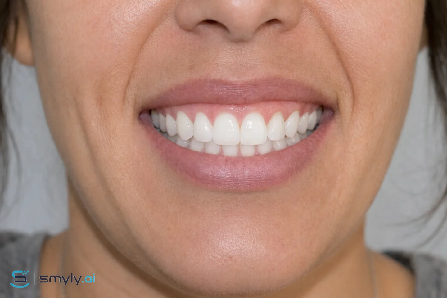 After: Smyly simulation of teeth whitening on the same smile